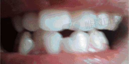 是做窝沟封闭的牙是什么牙,牙齿涂氟和窝沟封闭区别(图1)